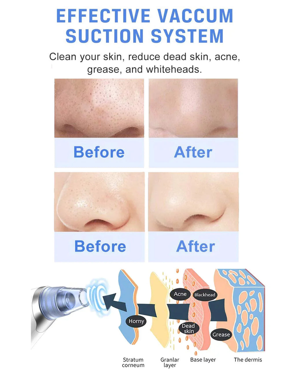 Vacuum Electric Remover Women Pore Sucker Nose Pore Blackhead Blackhead Remover Suction Vacuum Rechargeable Pore for Face Blackhead kit Men Facial Face Ansten USB Cleaner Pimple Cleaner