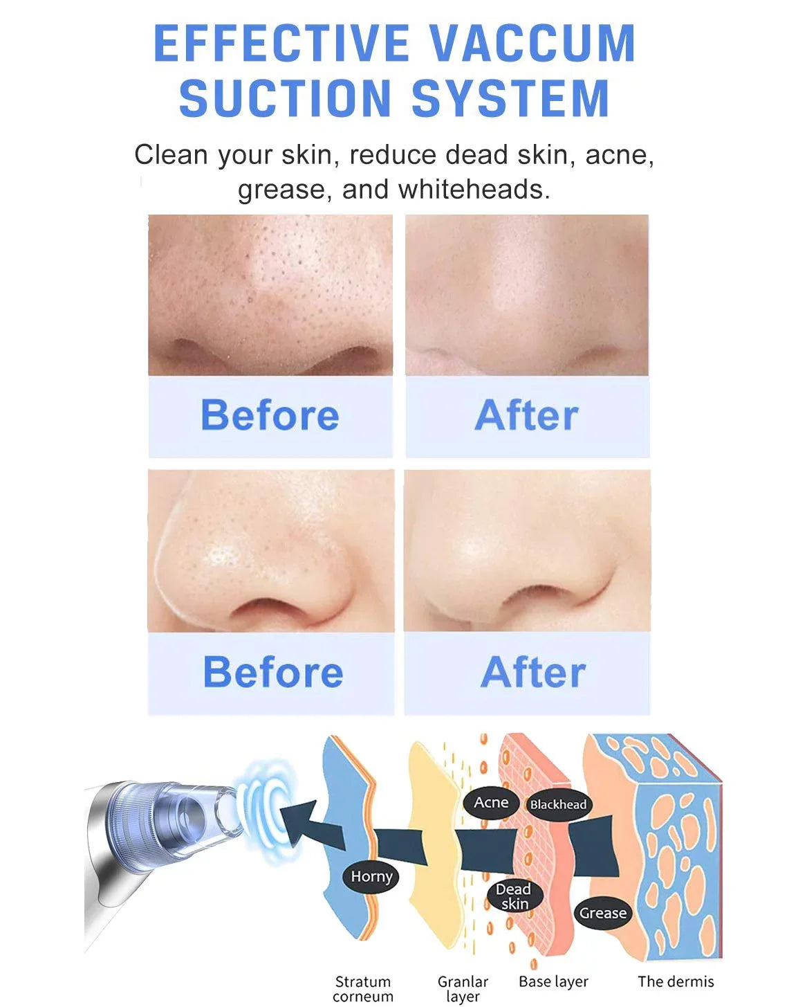 Vacuum Electric Remover Women Pore Sucker Nose Pore Blackhead Blackhead Remover Suction Vacuum Rechargeable Pore for Face Blackhead kit Men Facial Face Ansten USB Cleaner Pimple Cleaner